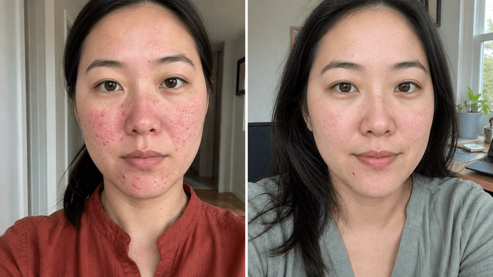 Evelyn's before and after using The Clarifying Rosacea Formula