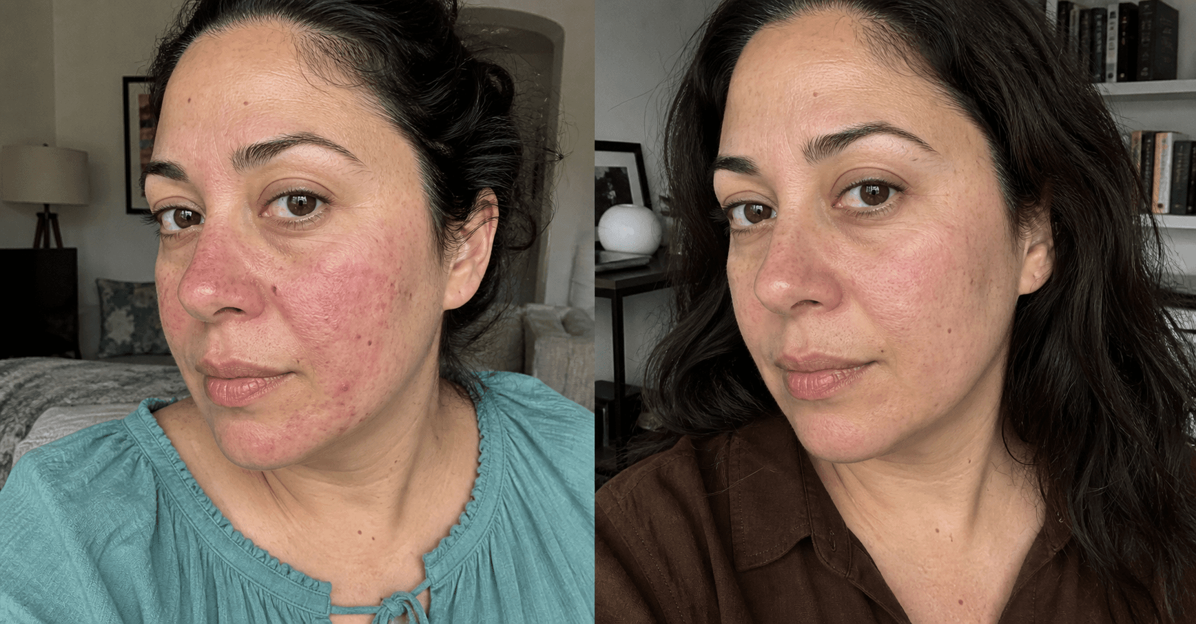 Farah's before and after using The Clarifying Rosacea Formula