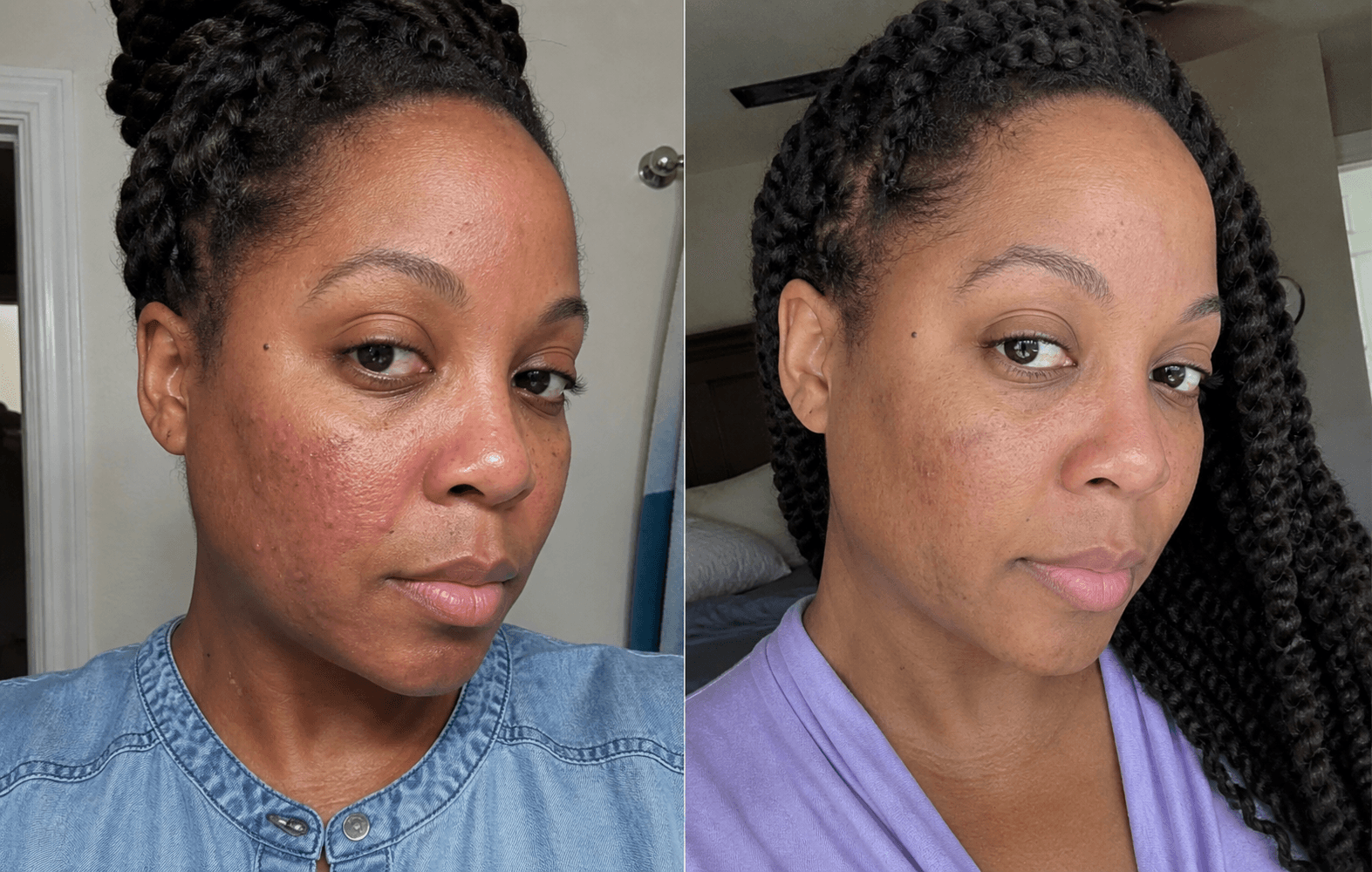 Imani's before and after using The Clarifying Rosacea Formula