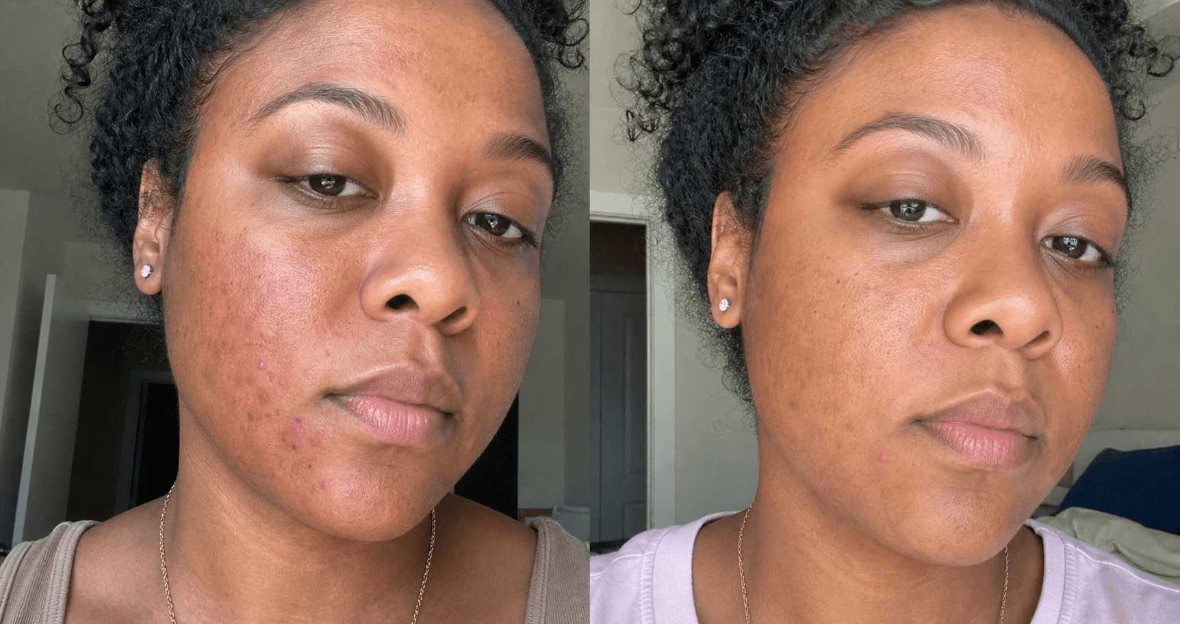 Claire's before and after using The Redness & Acne Formula
