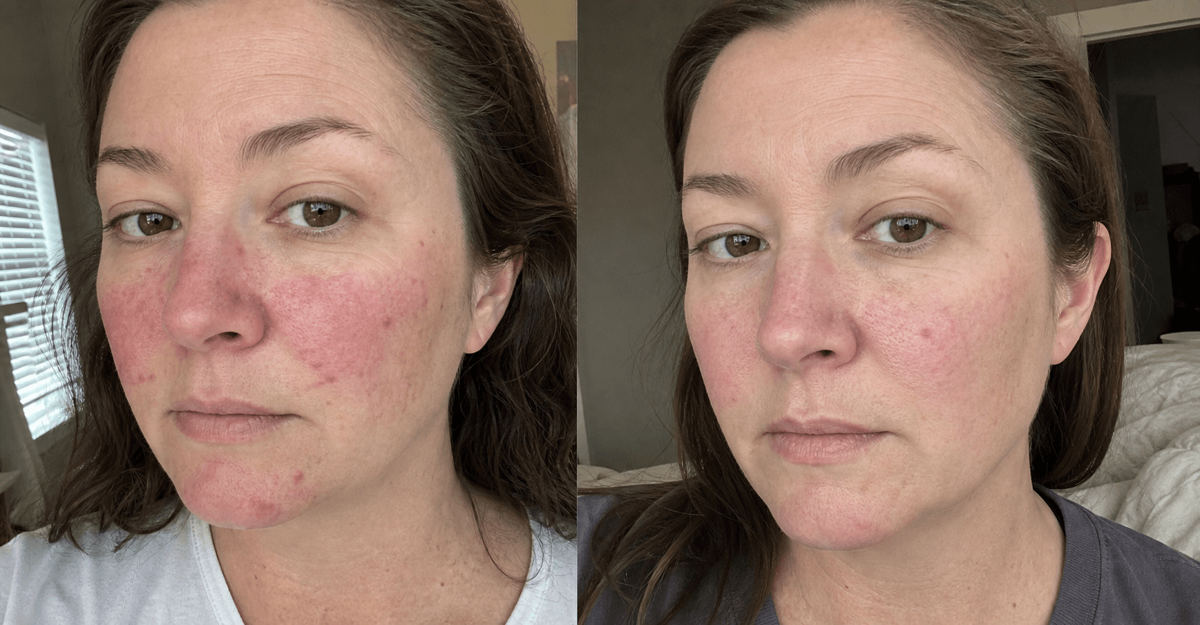 Brielle's before and after using The Redness & Acne Formula
