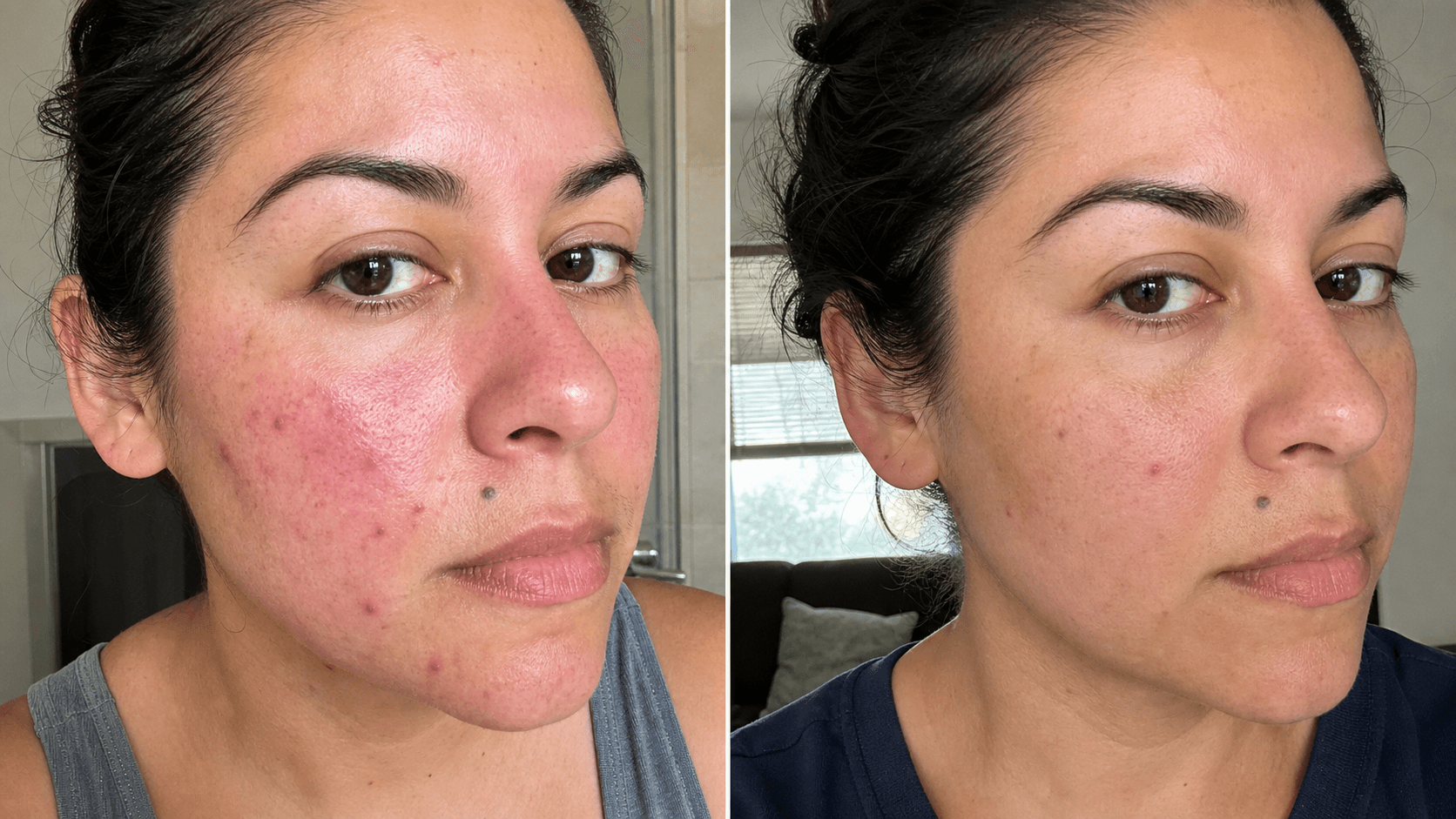 Valeria's before and after using The Redness & Acne Formula