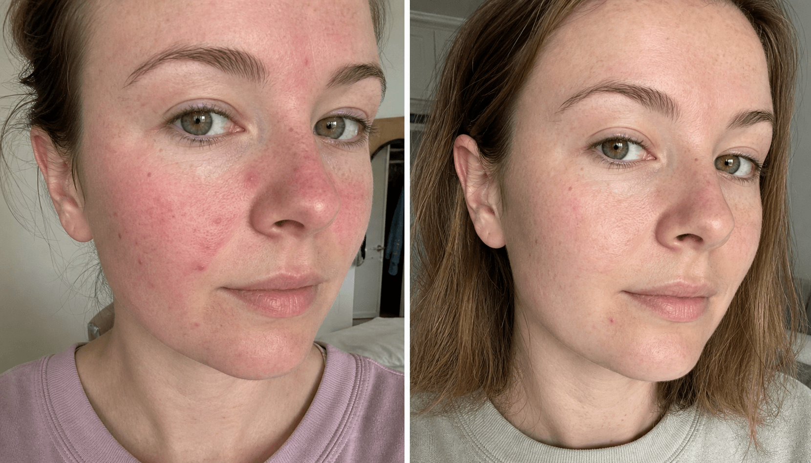 Olivia's before and after using The Redness & Acne Formula