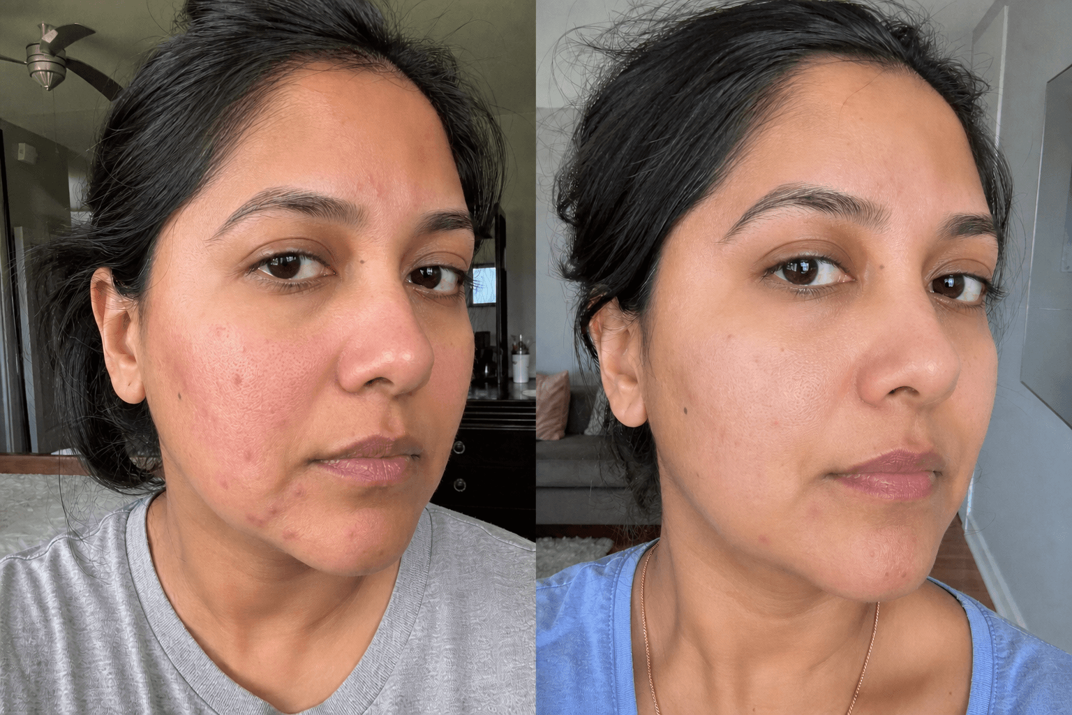 Nisha's before and after using The Redness & Acne Formula
