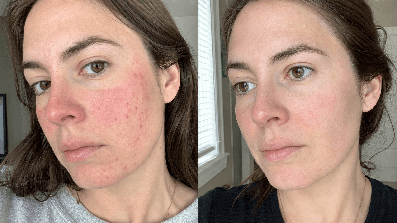 Brooke's before and after using The Redness & Acne Formula