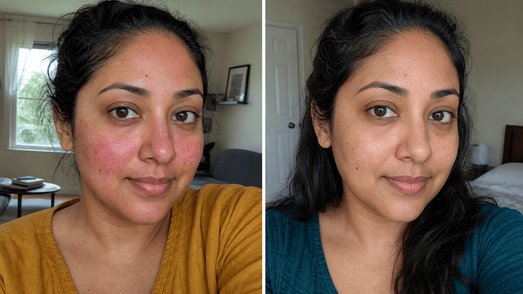 Alana's before and after using The Redness Control Formula