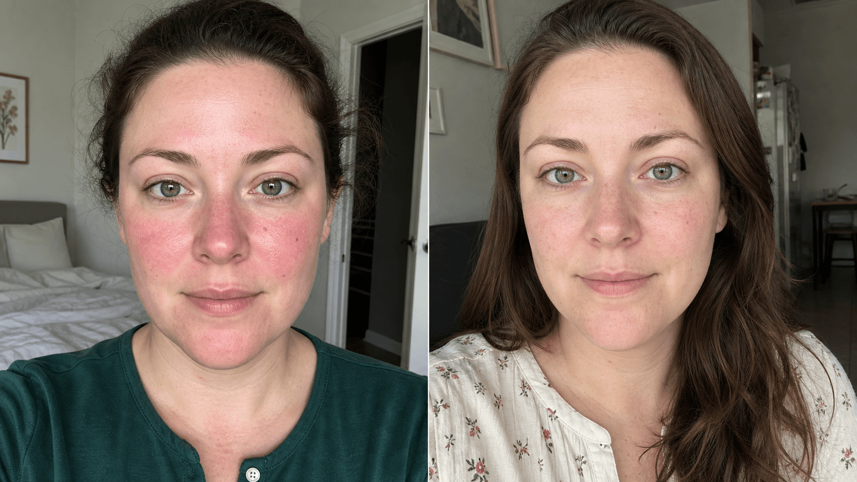 Celine's before and after using The Redness Control Formula