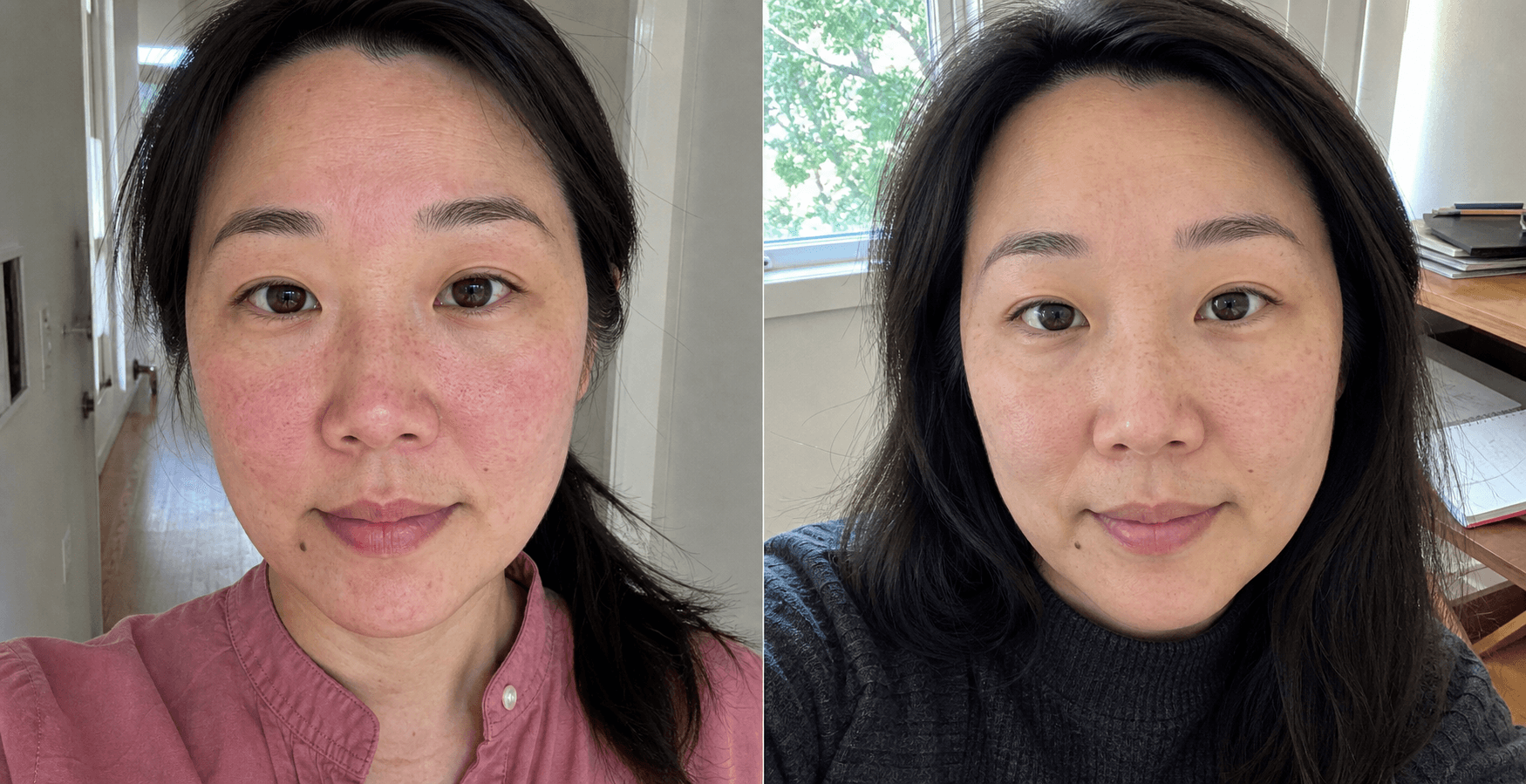 Jiwoo's before and after using The Redness Control Formula