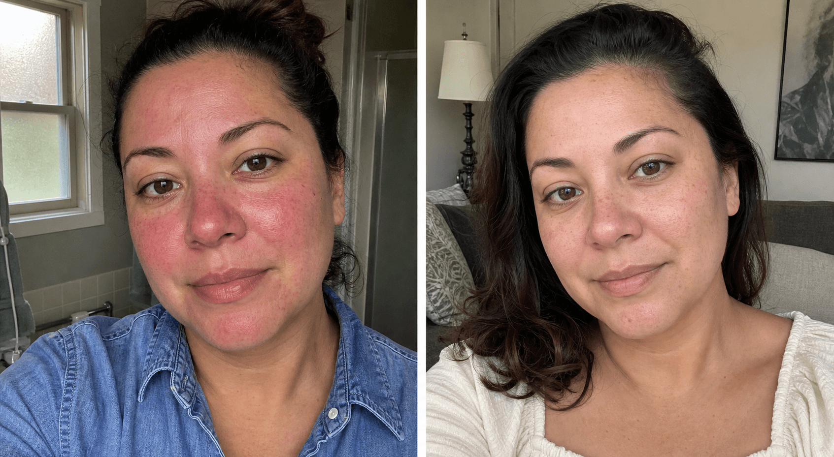 Marissa's before and after using The Redness Control Formula