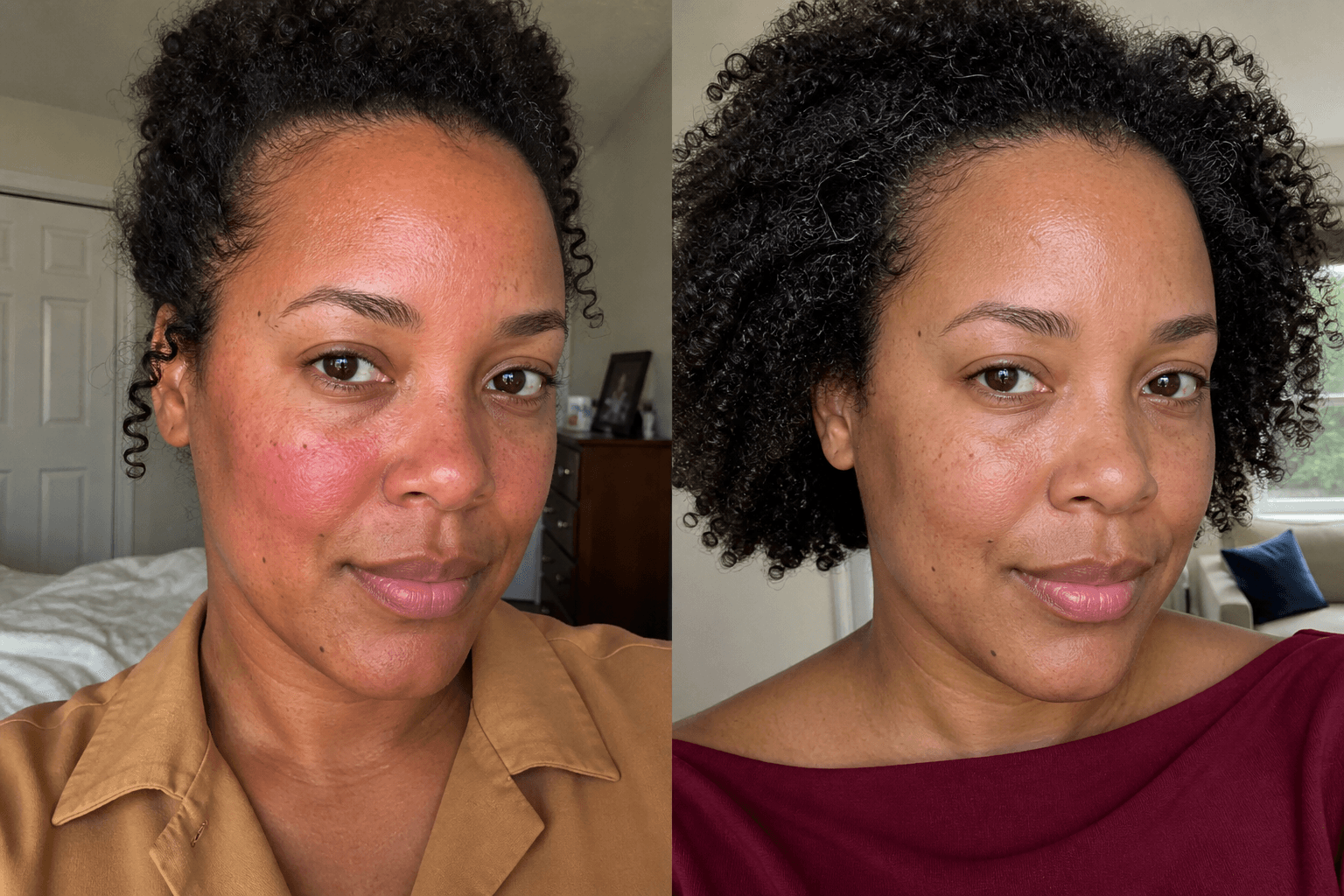 Nia's before and after using The Redness Control Formula