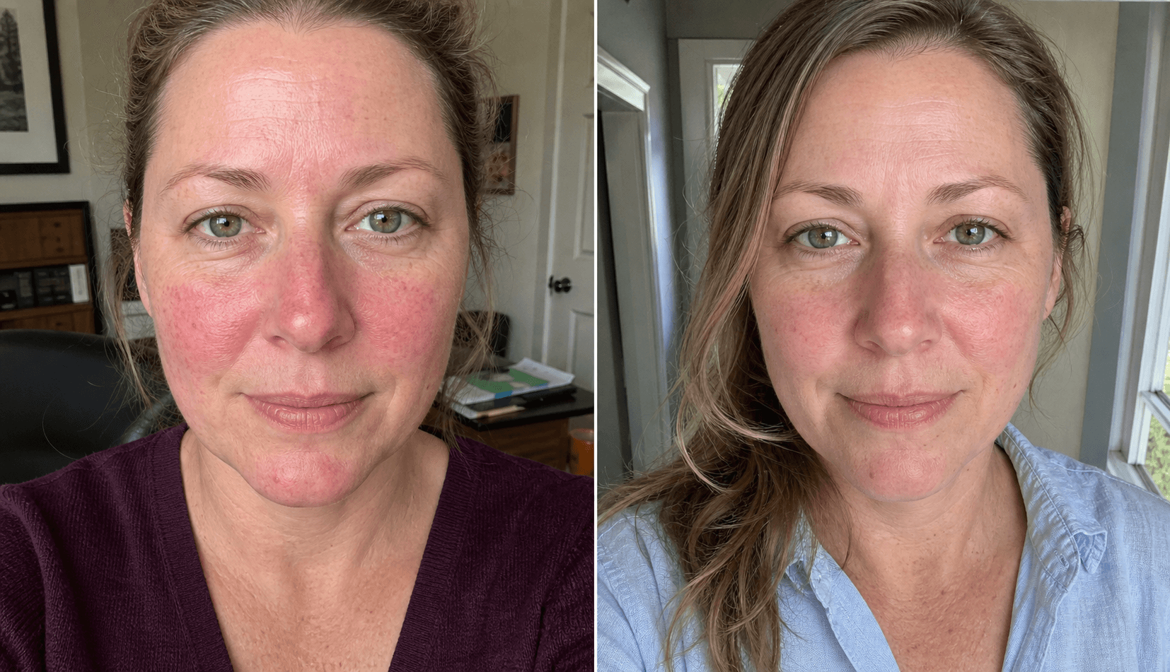 Tessa's before and after using The Redness Control Formula