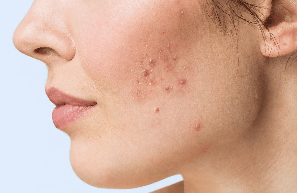 Close-up of skin with active, inflamed breakouts