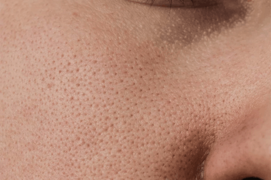 Close-up of skin with clogged-looking, congested pores