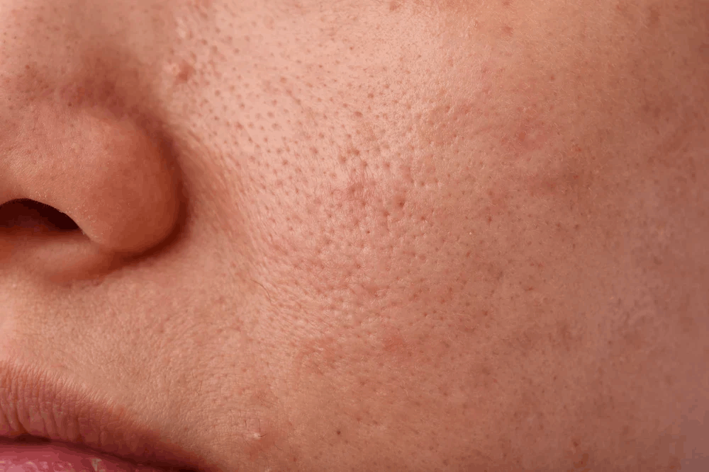 Close-up of skin with clogged pores