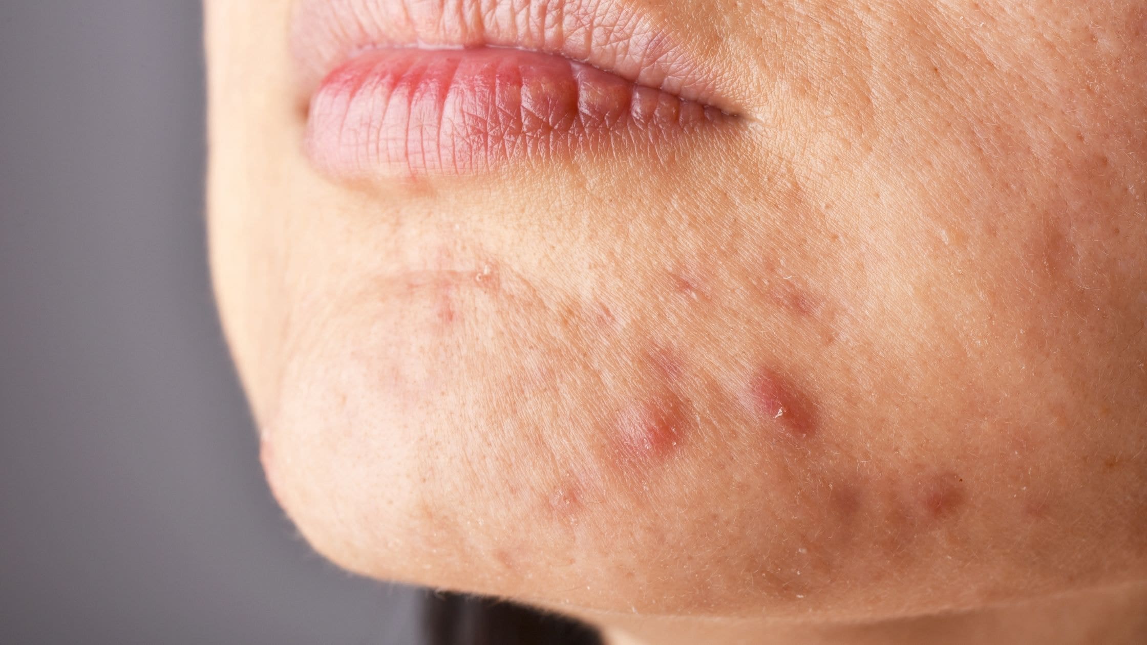 Close-up of skin with a deep blemish