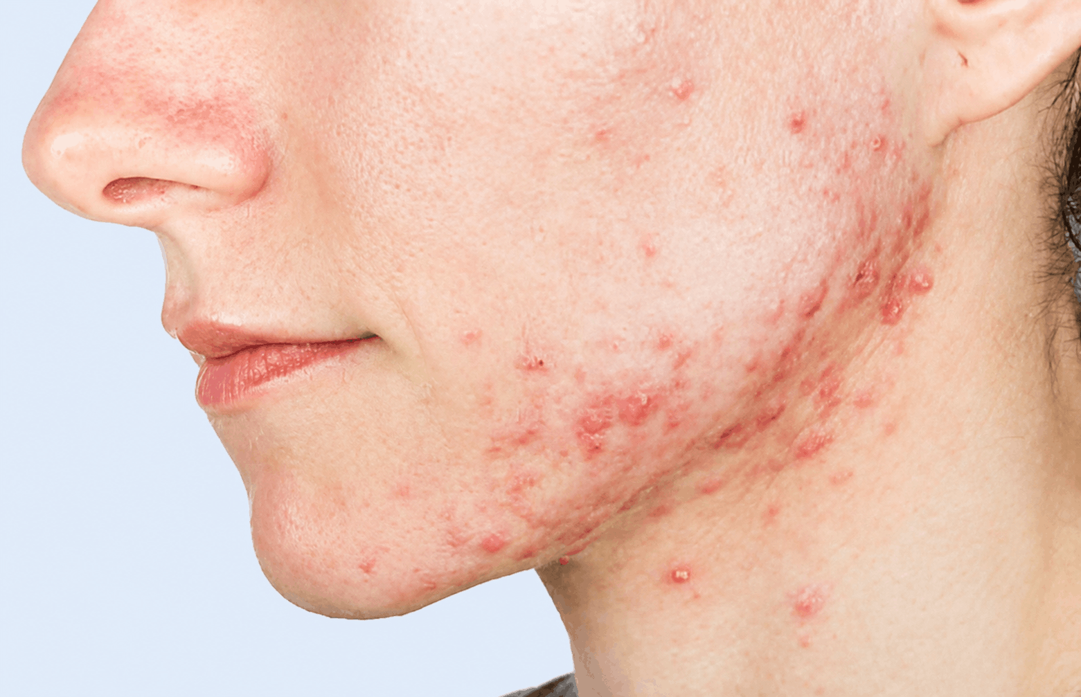 Close-up of skin with red, inflamed breakouts