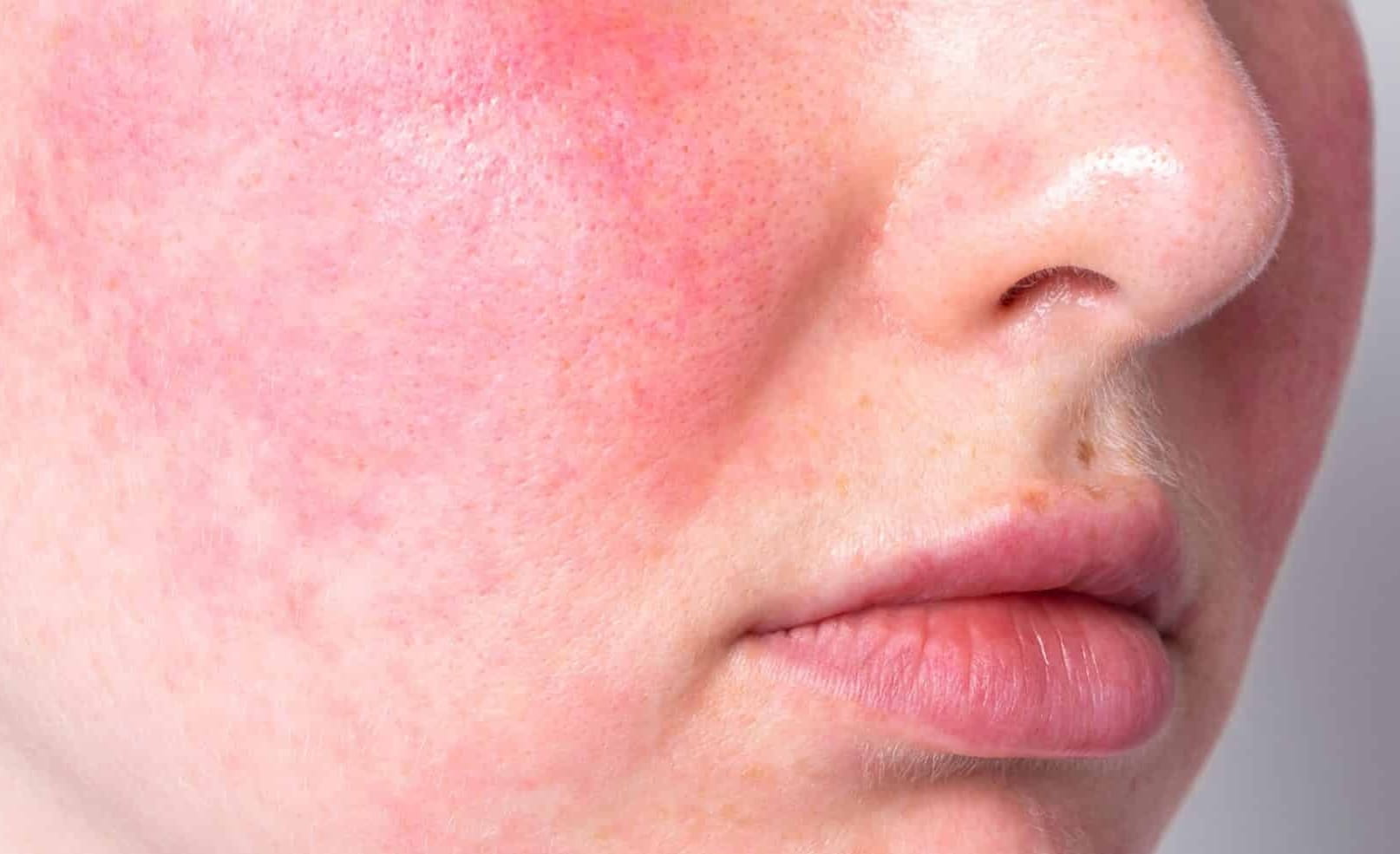 Close-up of face showing a rosacea flare-up
