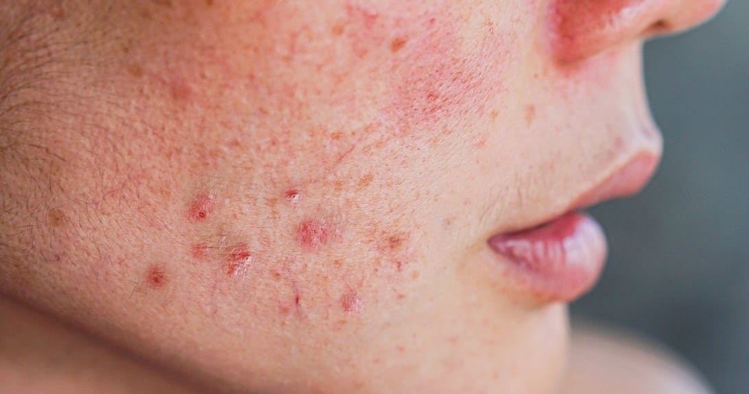 Close-up of skin showing acne