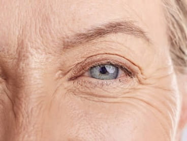 Close-up of the eye area showing deep-set wrinkles and crow's feet