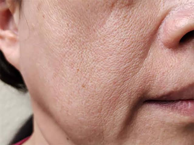 Close-up of the cheek and jawline showing loss of skin firmness