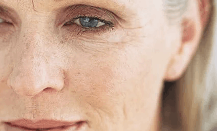 Close-up of the face showing sun damage, fine lines, and freckling