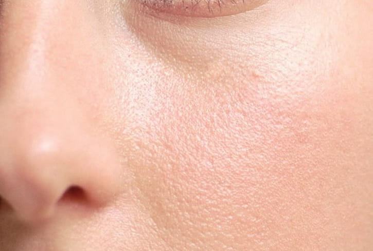 Close-up of the cheek showing rough, uneven skin texture and visible pores