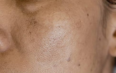 Close-up of the cheek showing uneven skin tone and dark spots