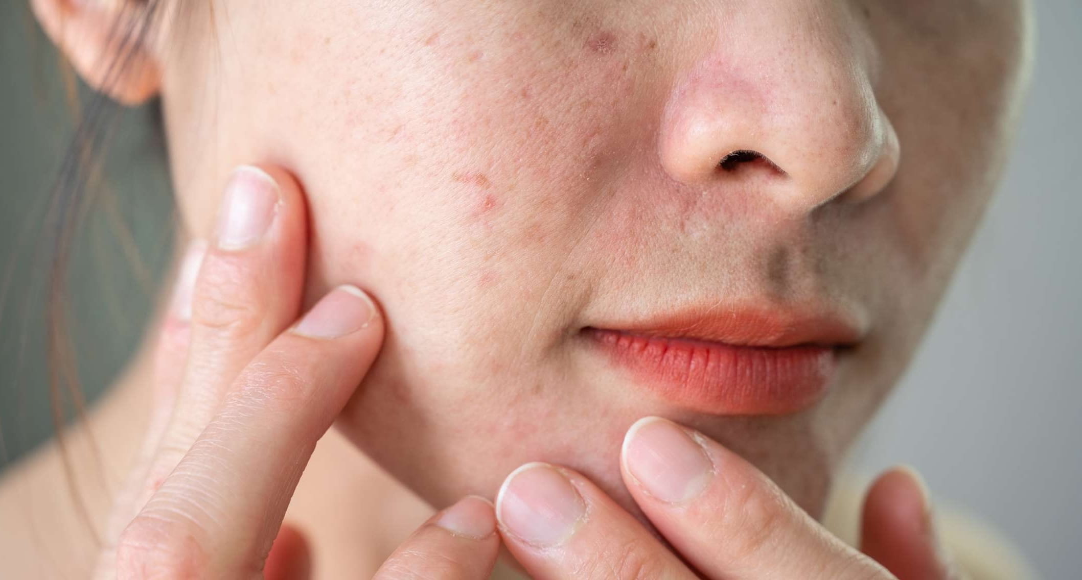 Close-up of uneven skin texture