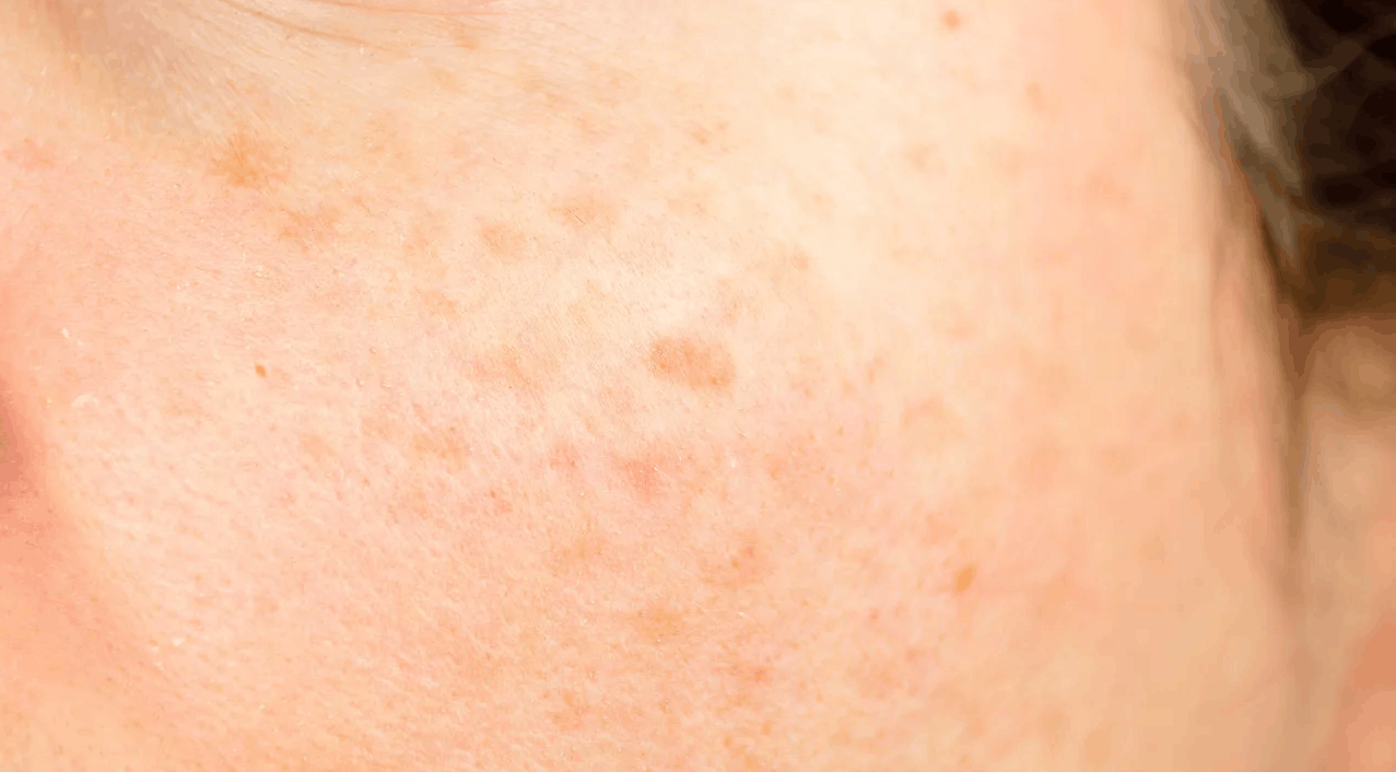 Close-up of skin showing signs of sun damage