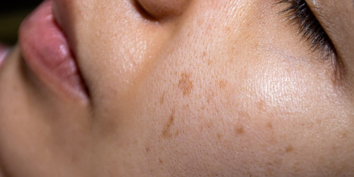 Close-up of uneven skin tone