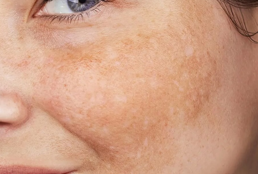 Close-up of cheek showing stubborn melasma pigmentation
