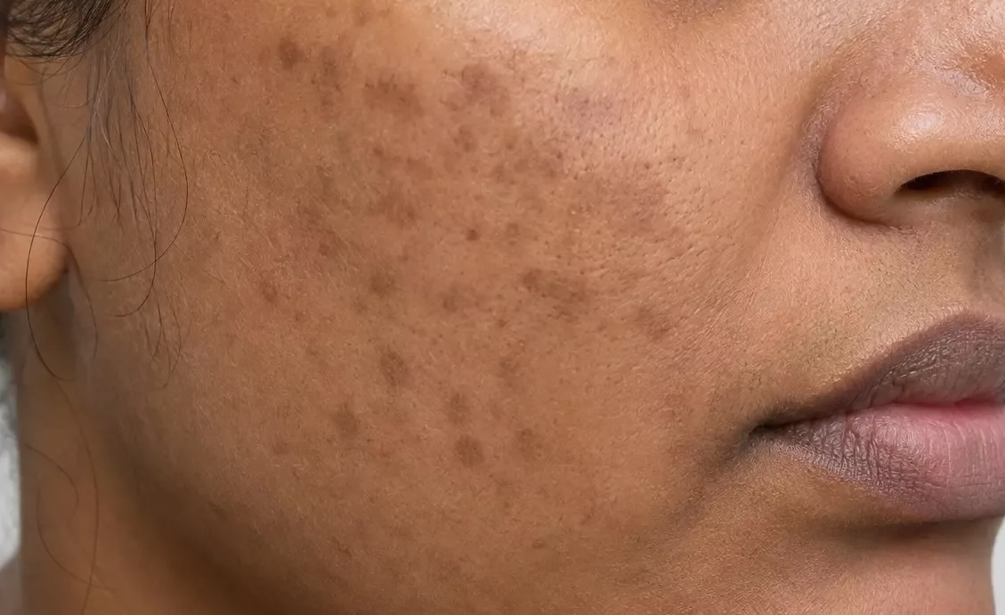 Close-up of cheek showing brown post-acne marks