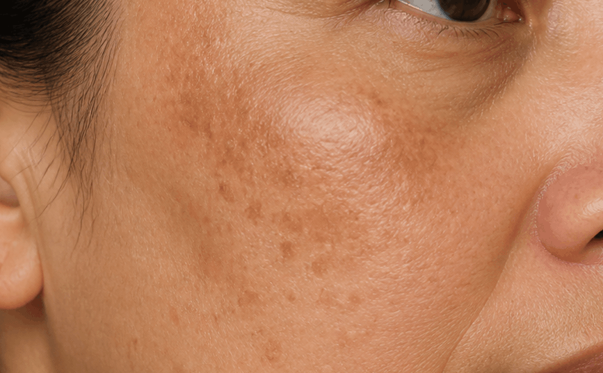 Close-up of cheek showing sun-related dark spots