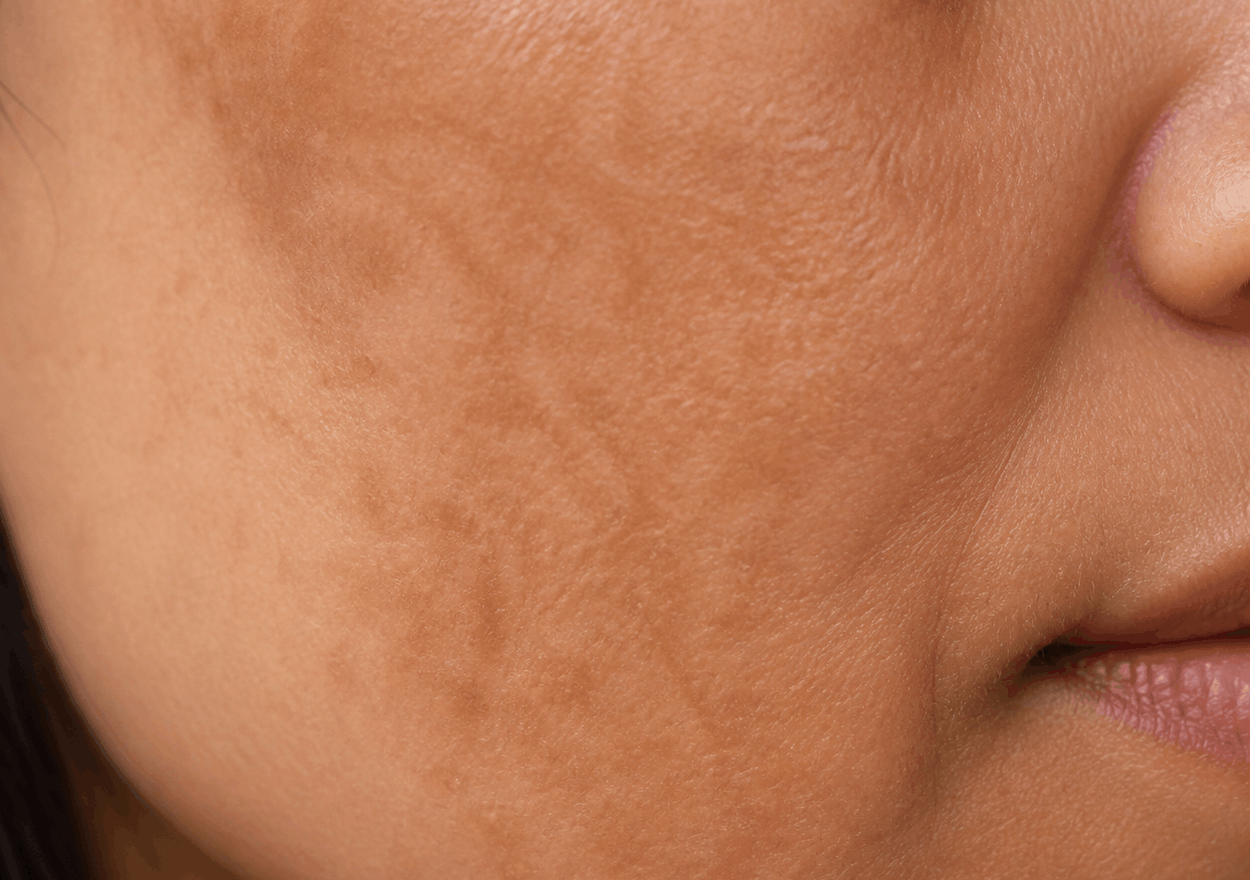 Close-up of cheek showing resistant uneven skin tone