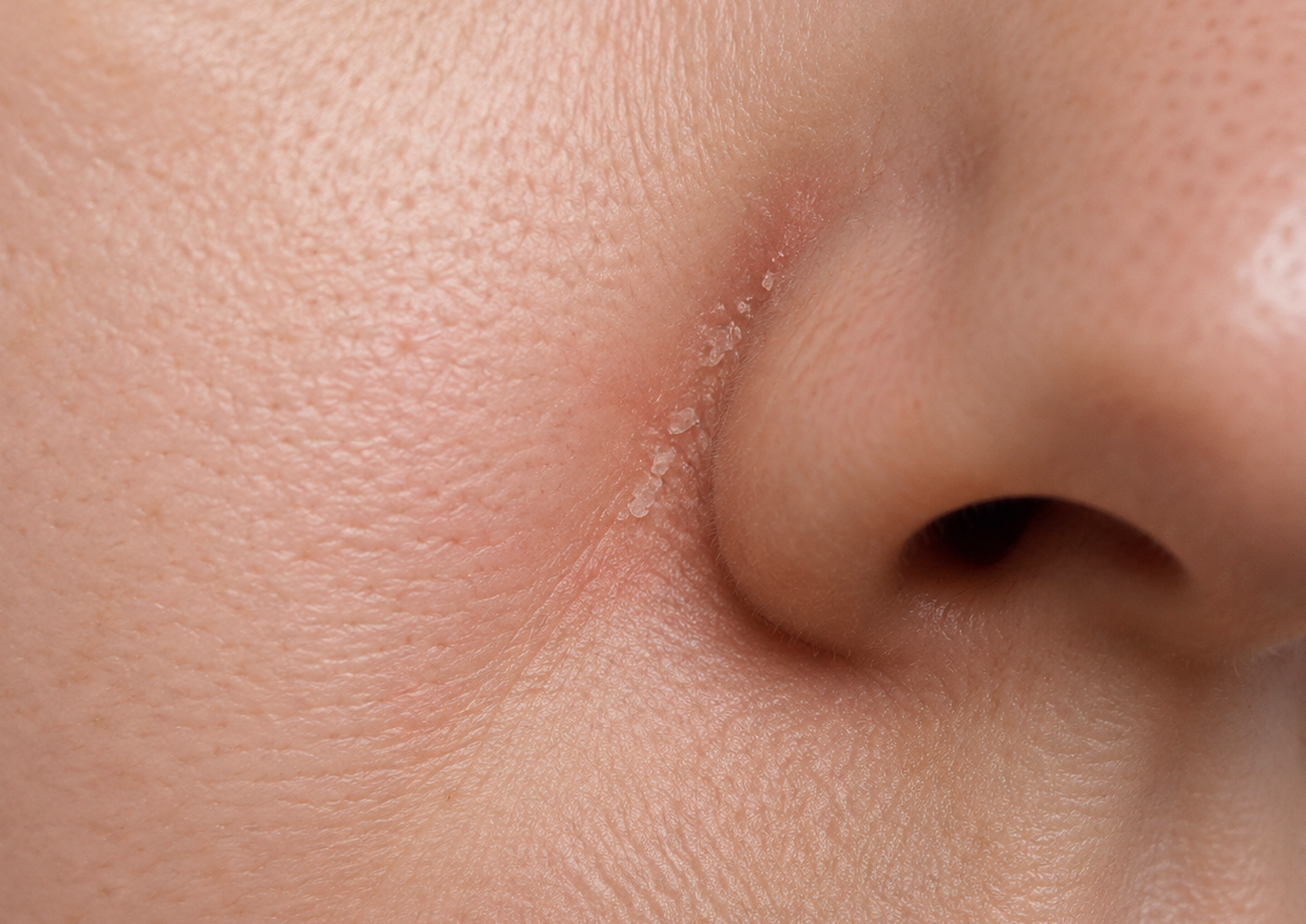 Close-up of flaky, greasy patches on rosacea-prone skin