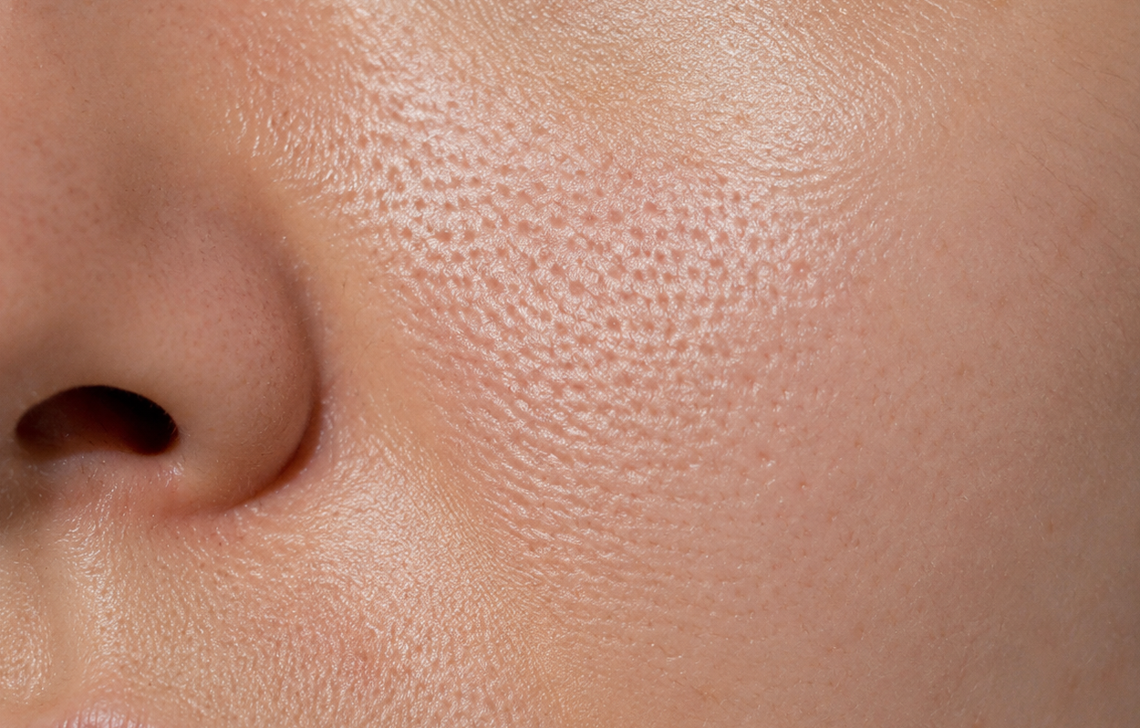 Close-up of oily, congested skin