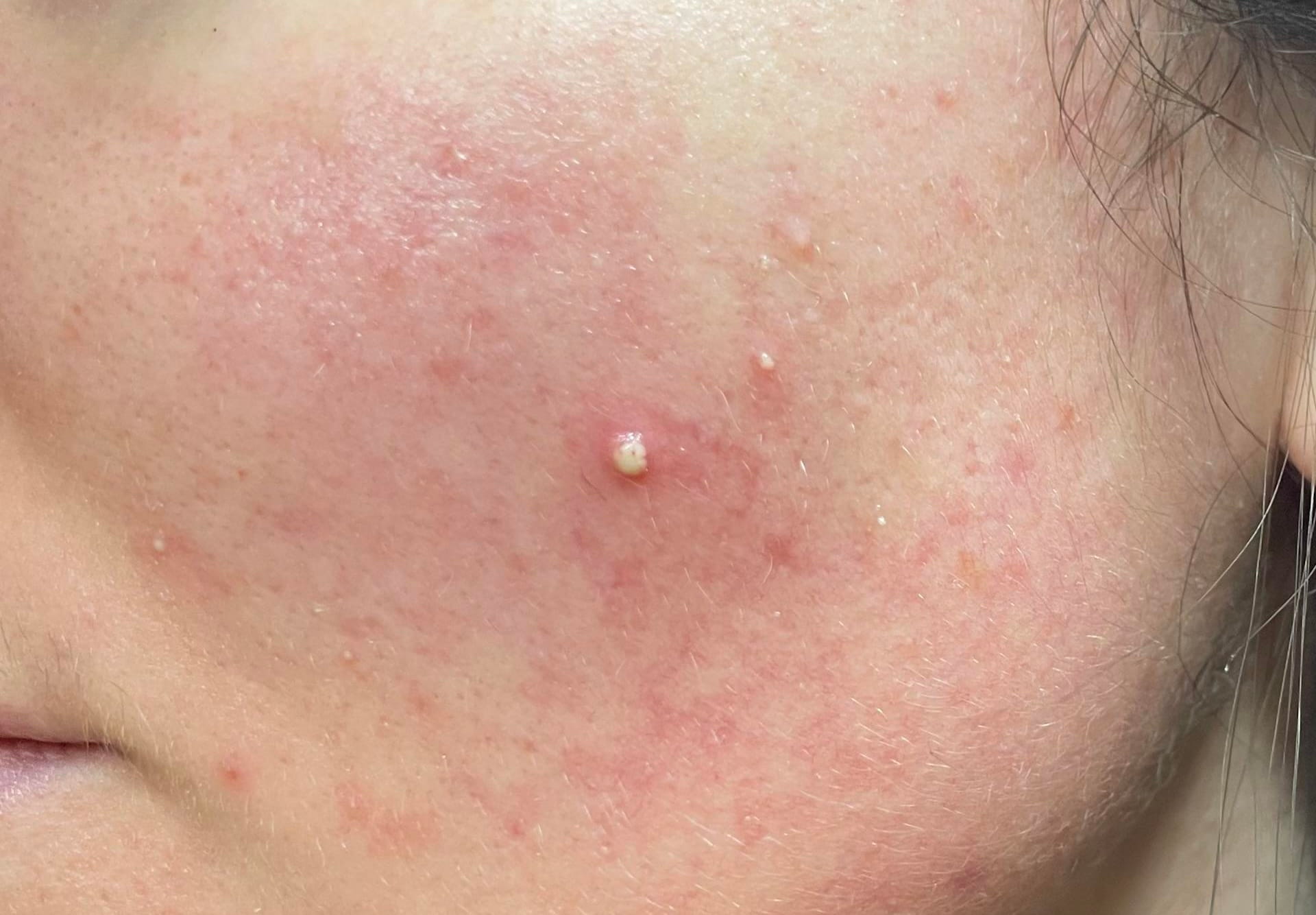 Close-up of pustules on rosacea-prone skin