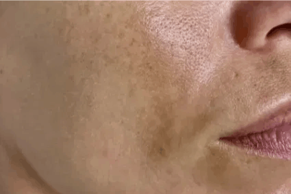 Close-up of cheek showing melasma pigmentation