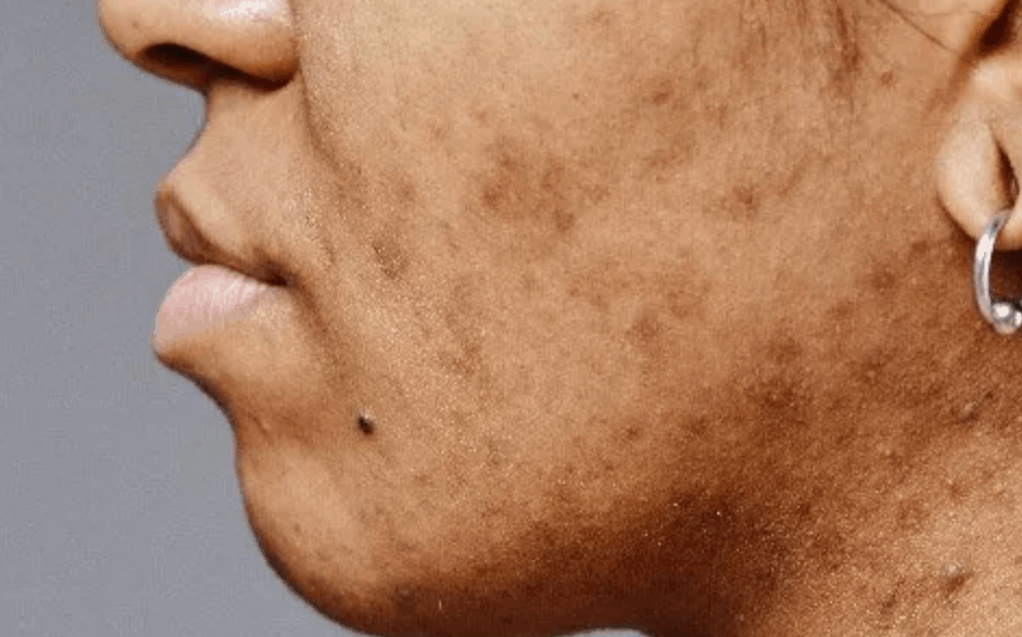 Close-up of cheek showing post-acne dark spots