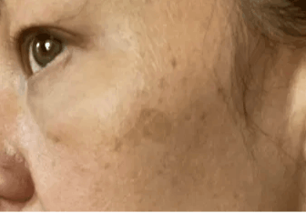 Close-up of cheek showing sun spot pigmentation