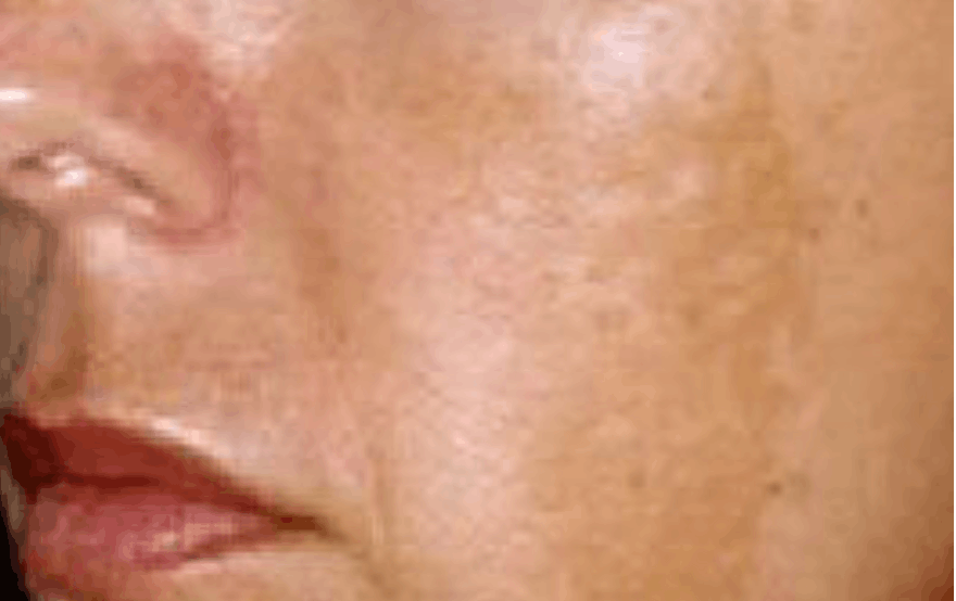 Close-up of cheek showing uneven skin tone