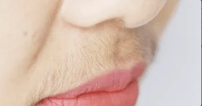 Close-up of upper lip showing thick, dark facial hair regrowth