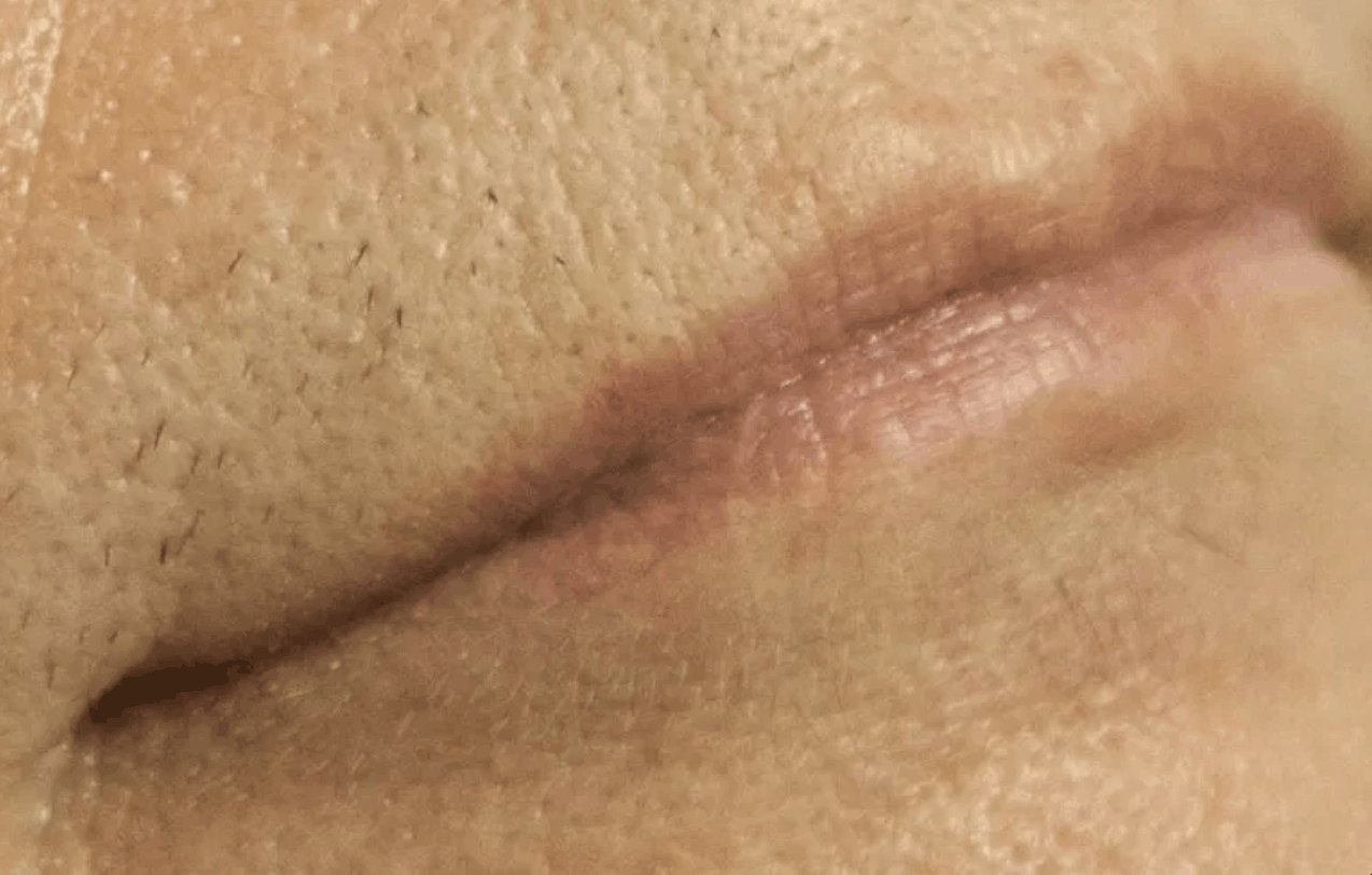 Close-up of an upper lip area shortly after shaving, with visible regrowth