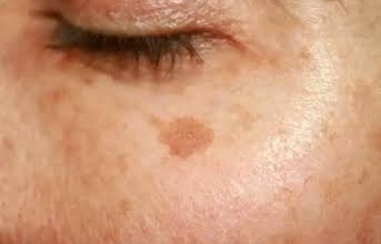 Close-up of a cheek showing a small, defined dark spot