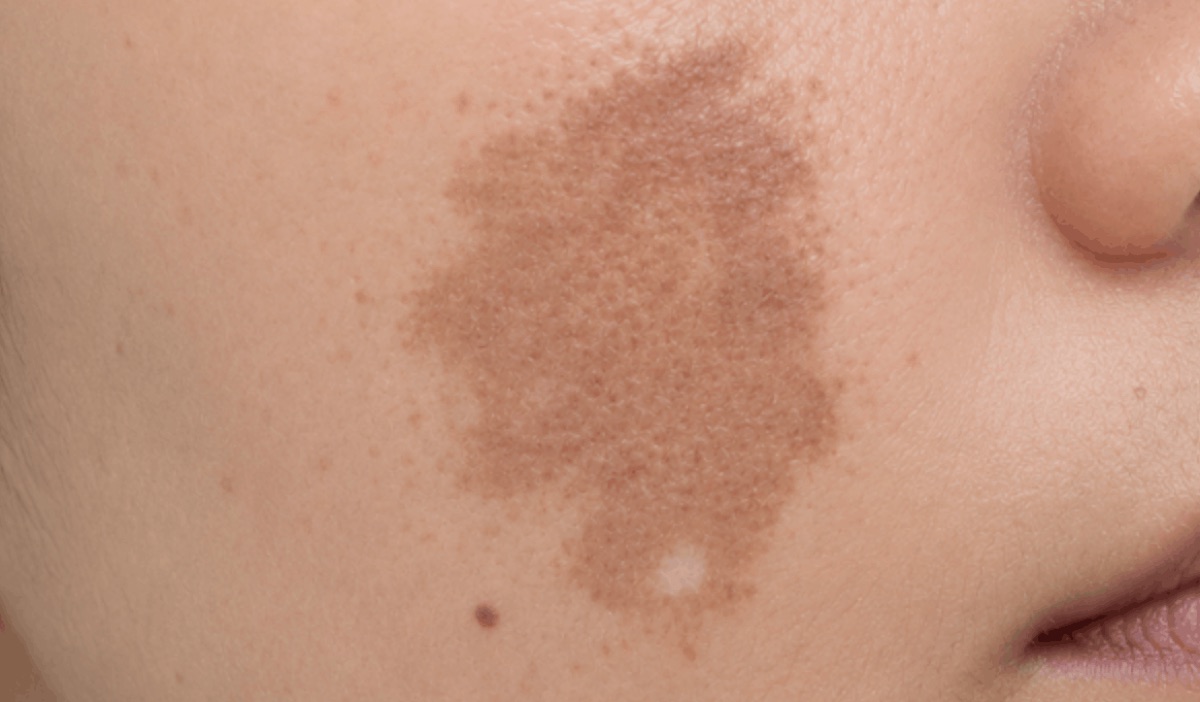 Close-up of a cheek showing a concentrated melasma patch
