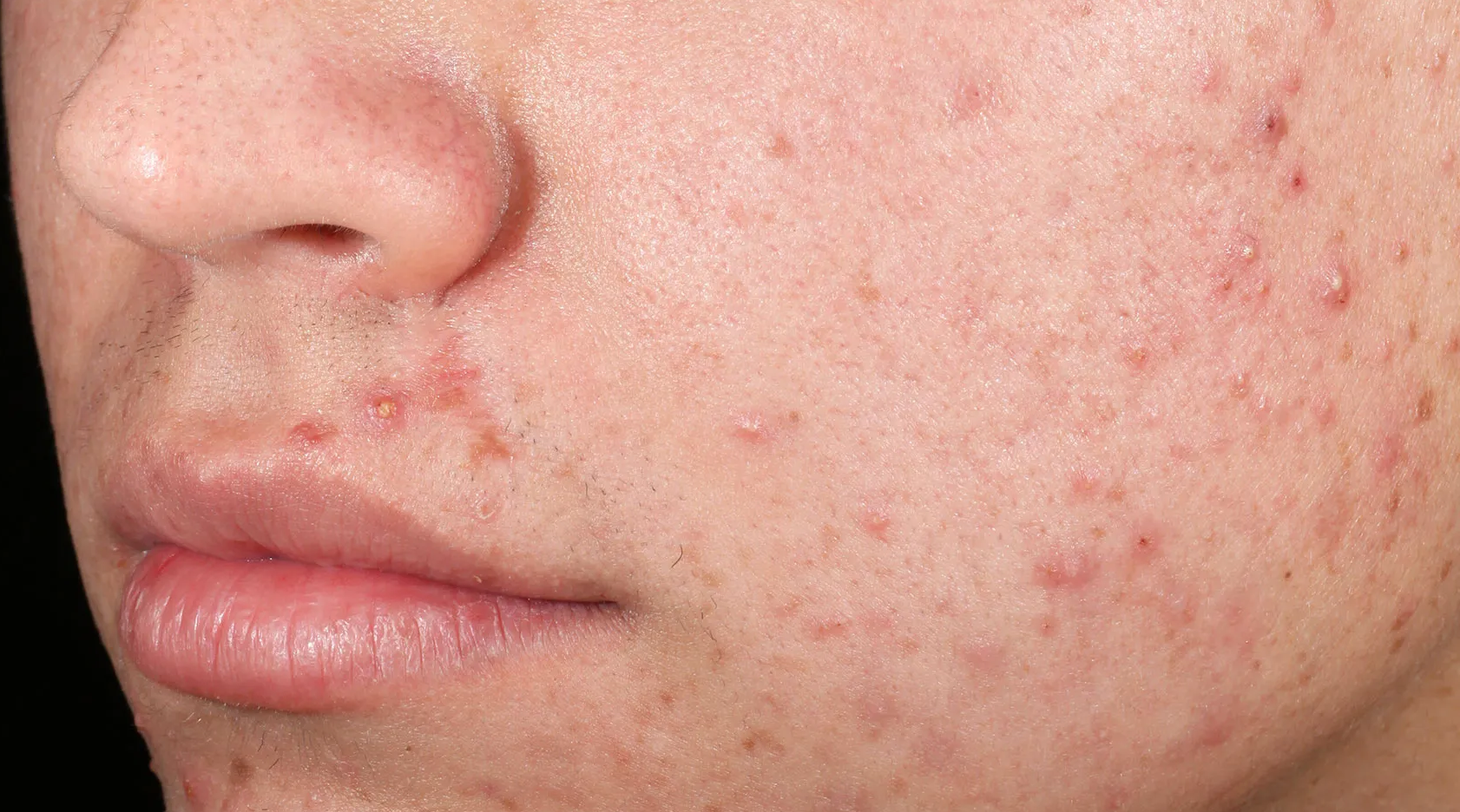 Close-up of skin with post-breakout red marks