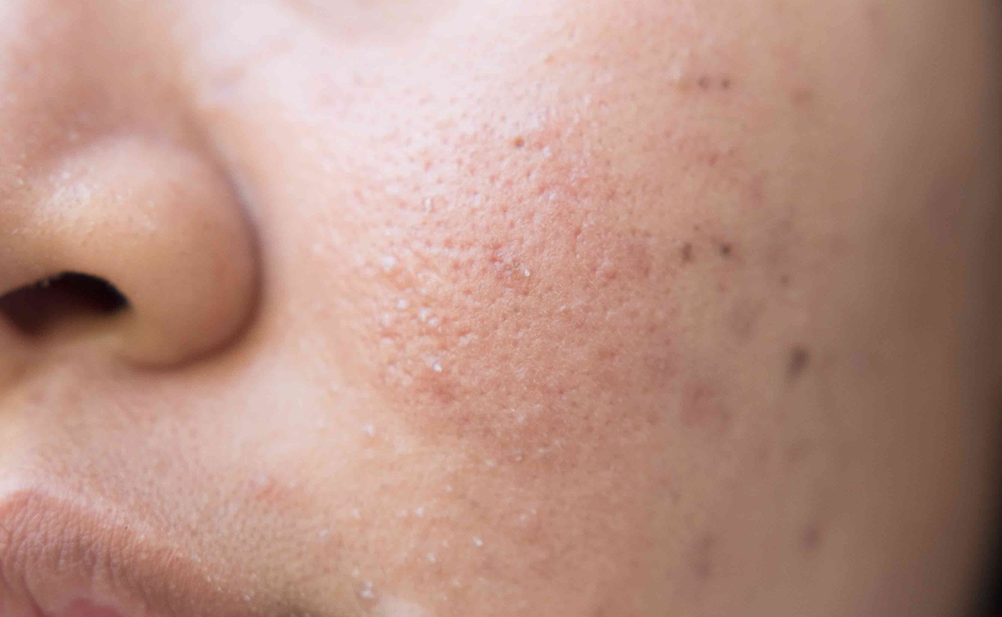 Close-up of skin showing uneven tone from post-acne discoloration