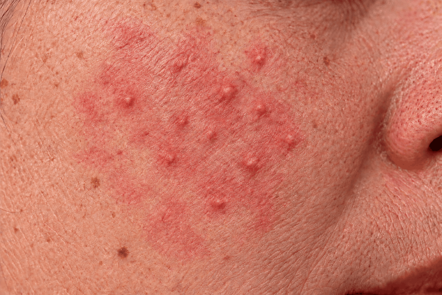 Close-up of cheek showing acne-like breakouts on rosacea-prone skin