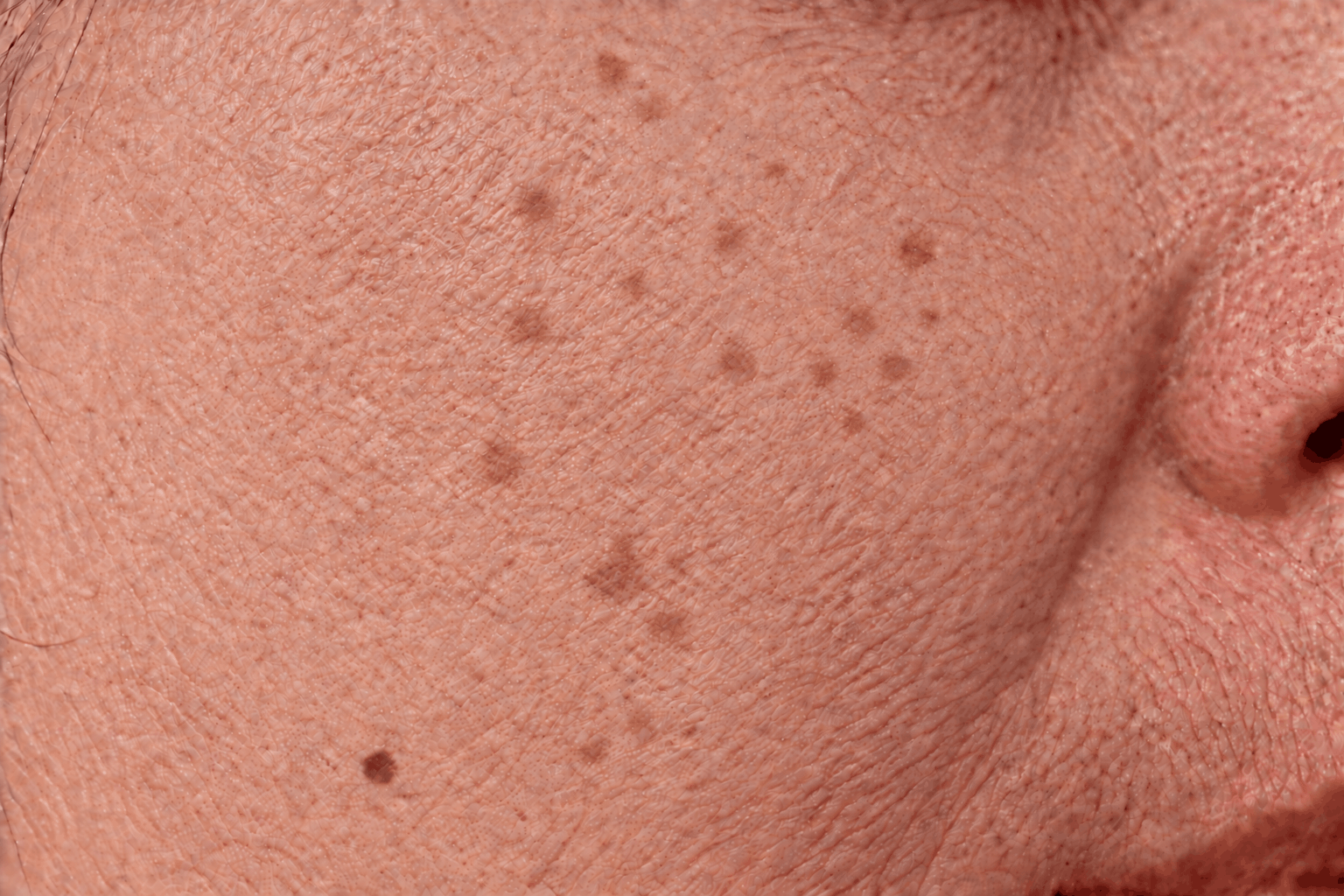 Close-up of cheek showing dark marks after breakouts