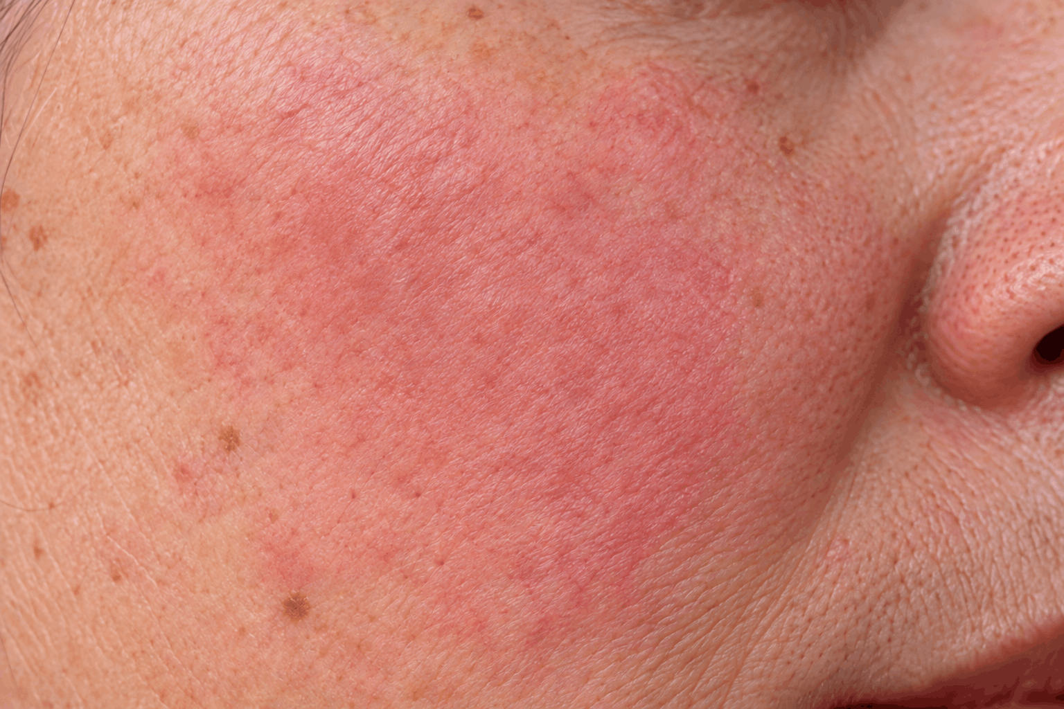 Close-up of cheek showing redness on reactive skin